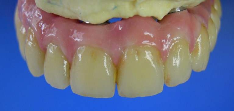 BRIDGE COMPLET TRANSVISSE ZIRCONE  