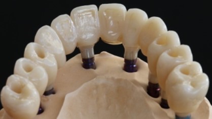 BRIDGE COMPLET TRANSVISSE ZIRCONE  