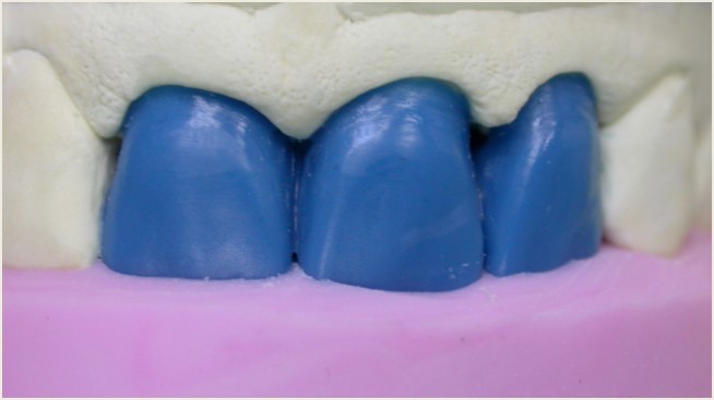 CONJOINTE - Wax up et clé silicone pour préparer les armatures