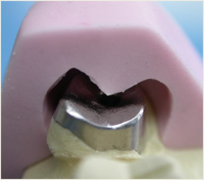 CONJOINTE - Wax up et clé silicone pour inlay-core
