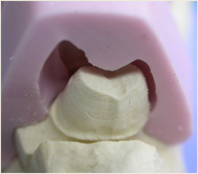 CONJOINTE - Wax up et clé silicone pour inlay-core