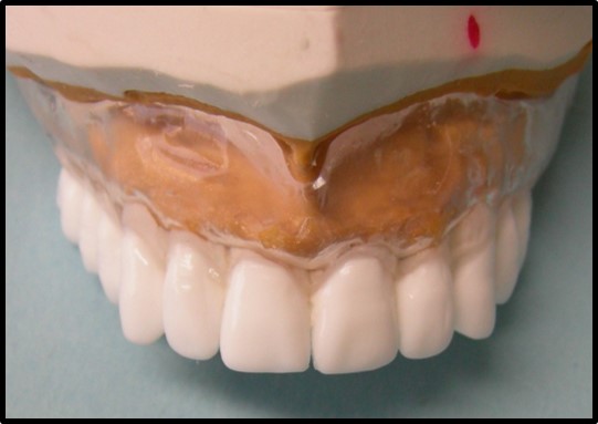 ADJOINTE - Le guide chirurgical pour édenté complet
