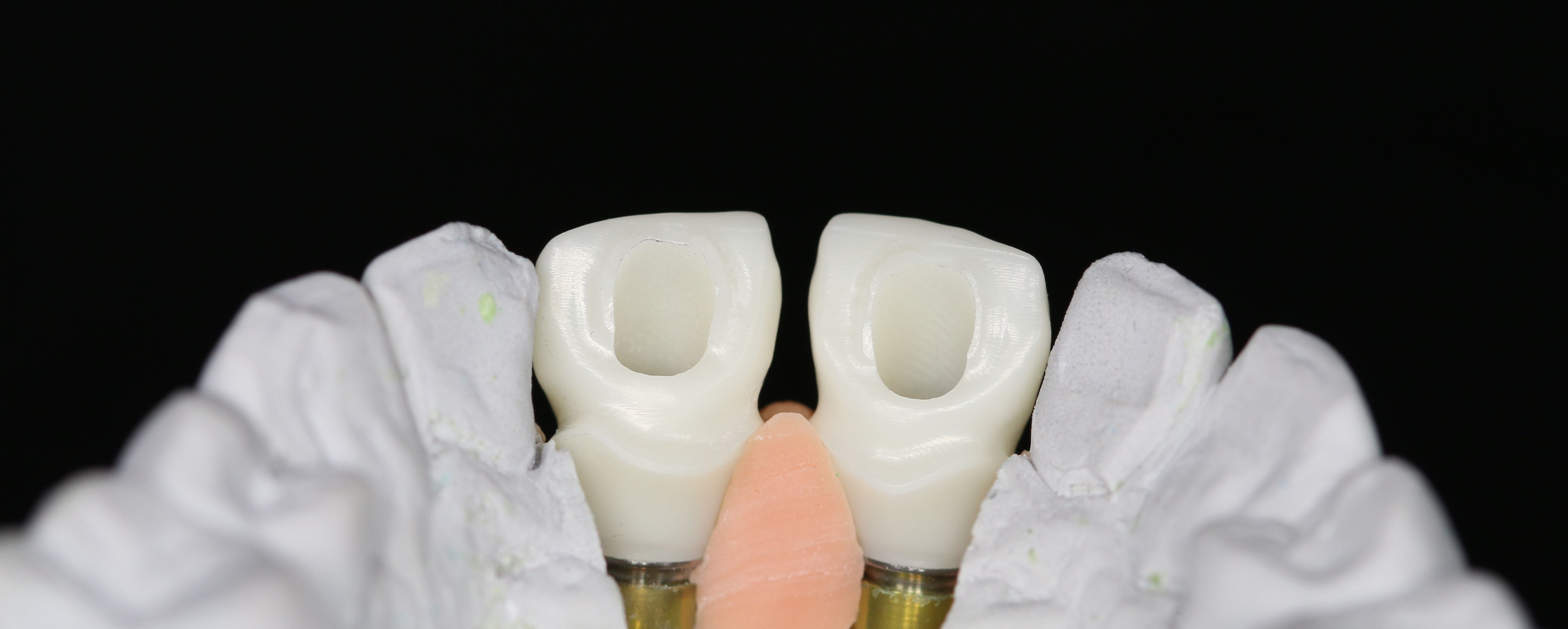 armature zircone transvissée