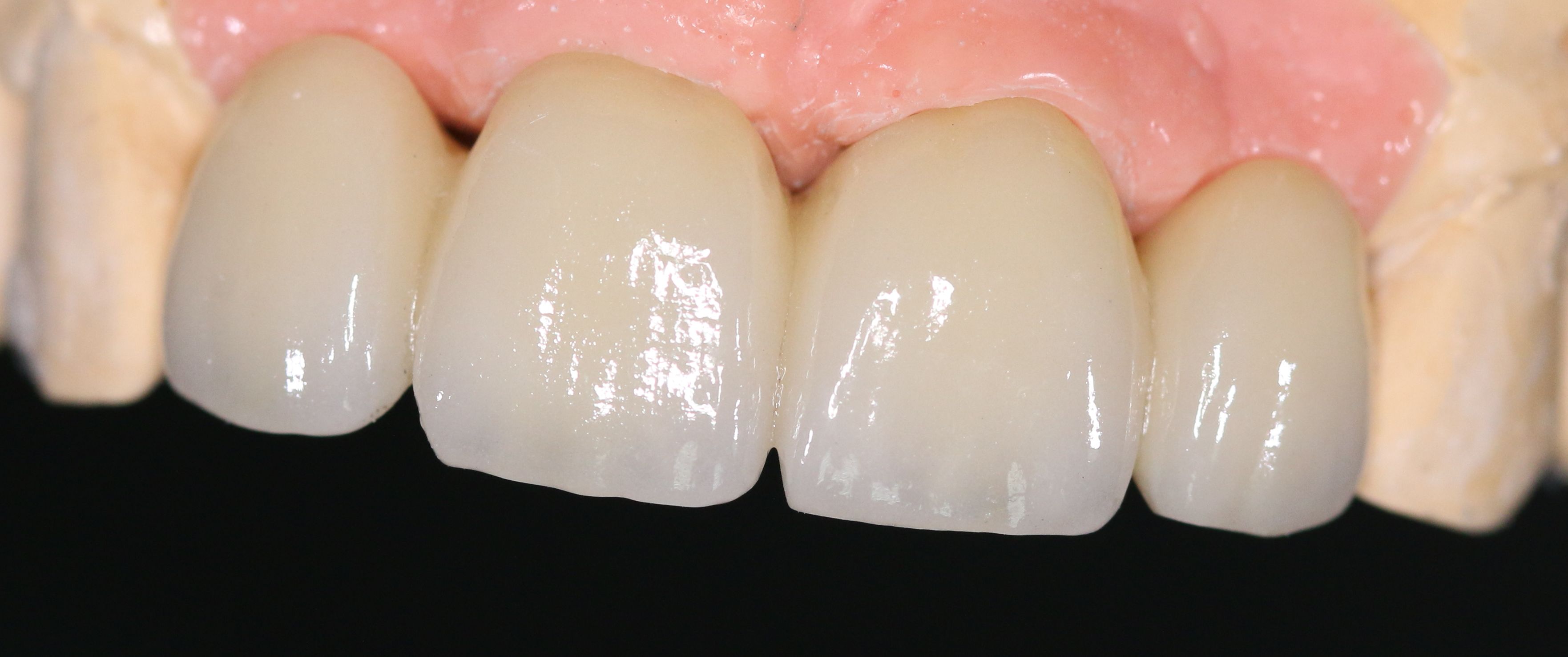Zircone transvissée, 11-21 et 12-22 en extension
