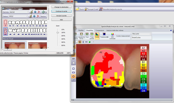 analyse-de-la-teinte-par-le-spectrocolorimetre-laboratoire-protheses-ceram-fixe.jpg