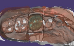 CONSTRUCTION NUMERIQUE D’UNE COURONNE