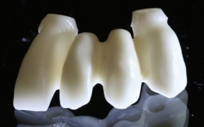 TRANSVISSEES IMPLANTAIRE ZIRCONE     
