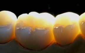 ZIRCONE STRATIFIEES     