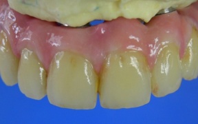 BRIDGE COMPLET TRANSVISSE ZIRCONE  