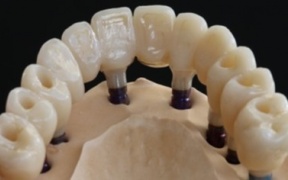 BRIDGE COMPLET TRANSVISSE ZIRCONE  