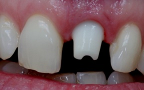 PILIER ET COURONNE ZIRCONE SCELLEE 