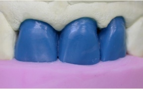 CONJOINTE - Wax up et clé silicone pour préparer les armatures