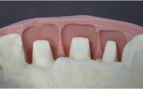 CONJOINTE - Wax up et clé silicone pour préparer les armatures