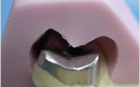 CONJOINTE - Wax up et clé silicone pour inlay-core