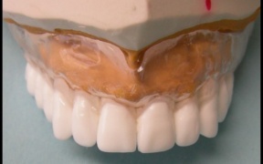 ADJOINTE - Le guide chirurgical pour édenté complet