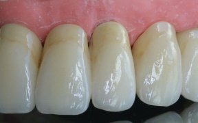 zircone