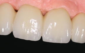Zircone transvissée, 11-21 et 12-22 en extension