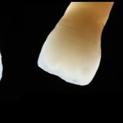 Zircones stratifiées