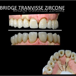 Bridge Transvissée Zirconne