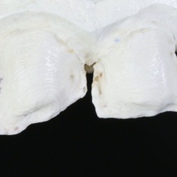 Préparation pour facettes e-max