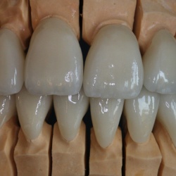 Zircones stratifiées