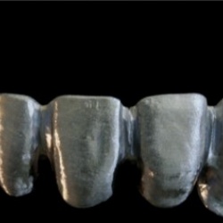 Bridge complet chrome cobalt usiné au laboratoire
