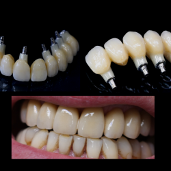 Bridge Zirconne Transvissé