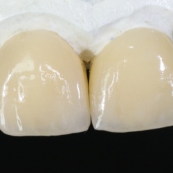 Facettes e-max