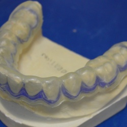 gouttières de fluoration