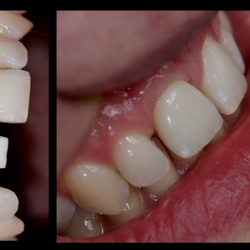 Piliers zircone et zircone scellée