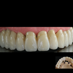 Bridge Zirconne Transvissé