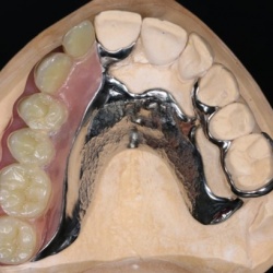 Stellite finition dents résine