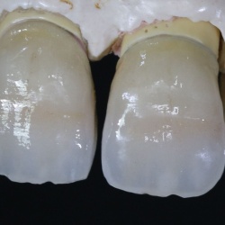 Céramiques armature métal