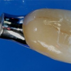 Transvissée métal