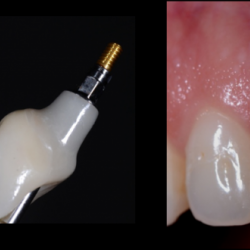 Zirconne Transvissée sur 11