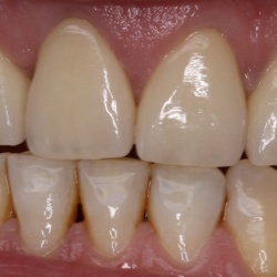 Zircones unitaires