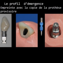 Transfert du profil avec le provisoire