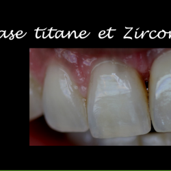 Zirconne Transvissée sur 21