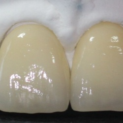 Facettes e-max