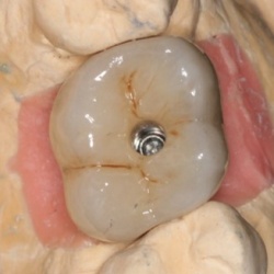 Zirconne Transvissée