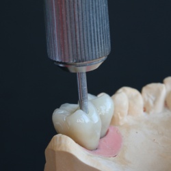 Zirconne Transvissée