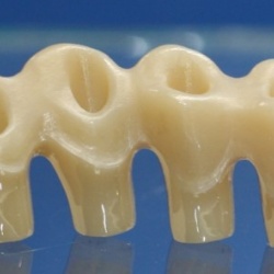 armature transvissée zircone