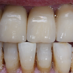 Facettes e-max