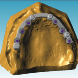 Modélisation Barre usinée Titane et attachements Locator