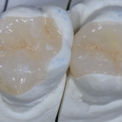 onlay Emax